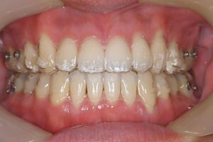 インビザライン（マウスピース）