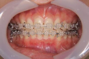 ワイヤー矯正（セラミック）