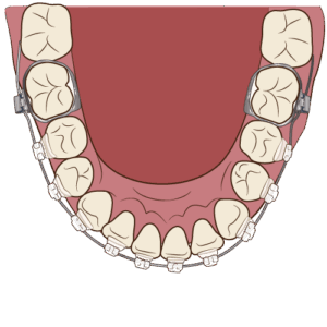 ブラケット矯正