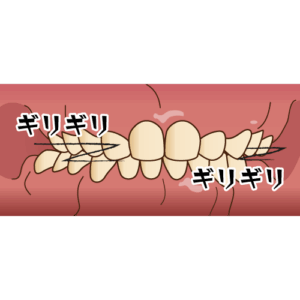 歯ぎしり