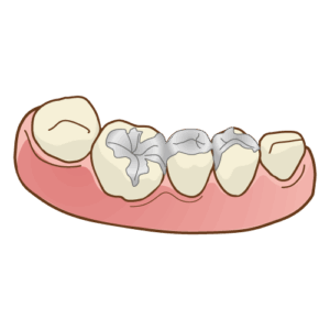 インレーブリッジ